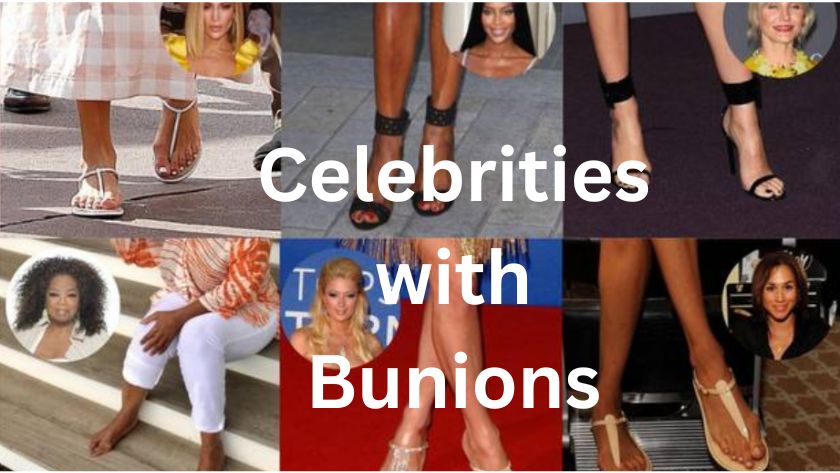 Celebrities with Bunions